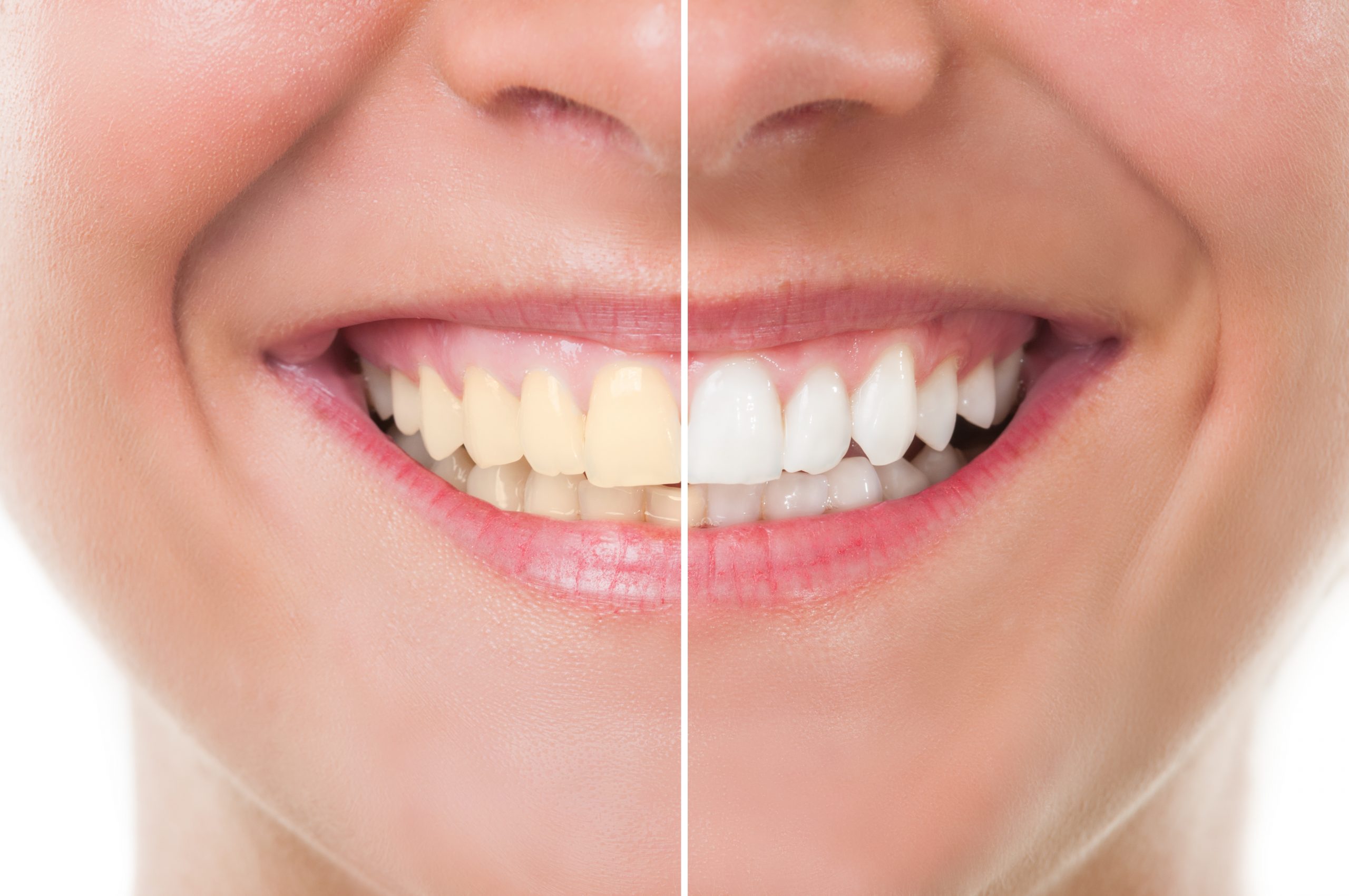 Cost of Teeth Whitening in Oxnard CA Gold Coast MediCal & DentiCal